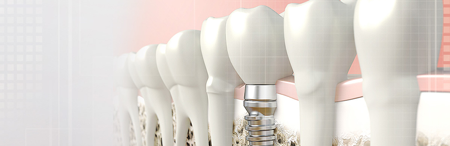 dental implants