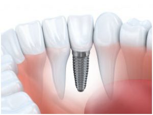 dental implant