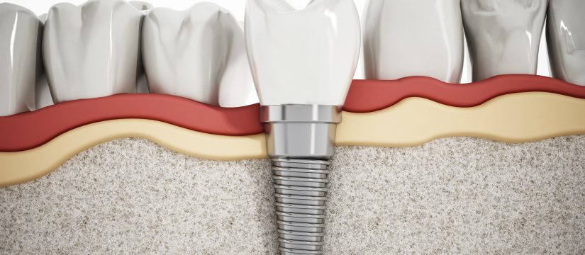 what are dental implants