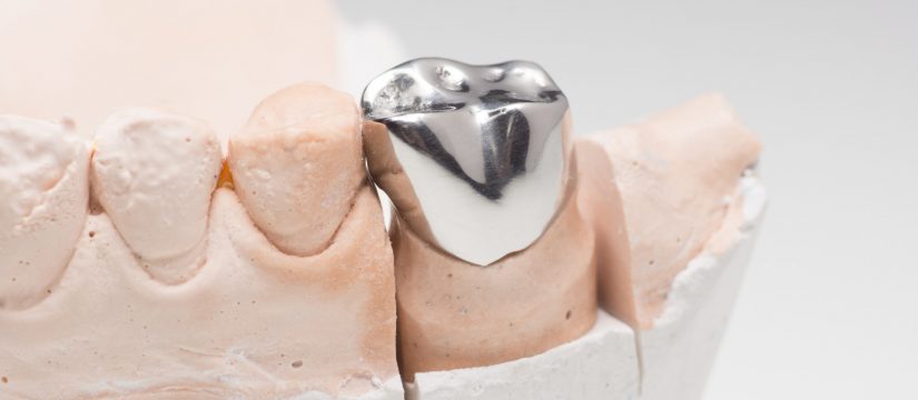types of dental crowns