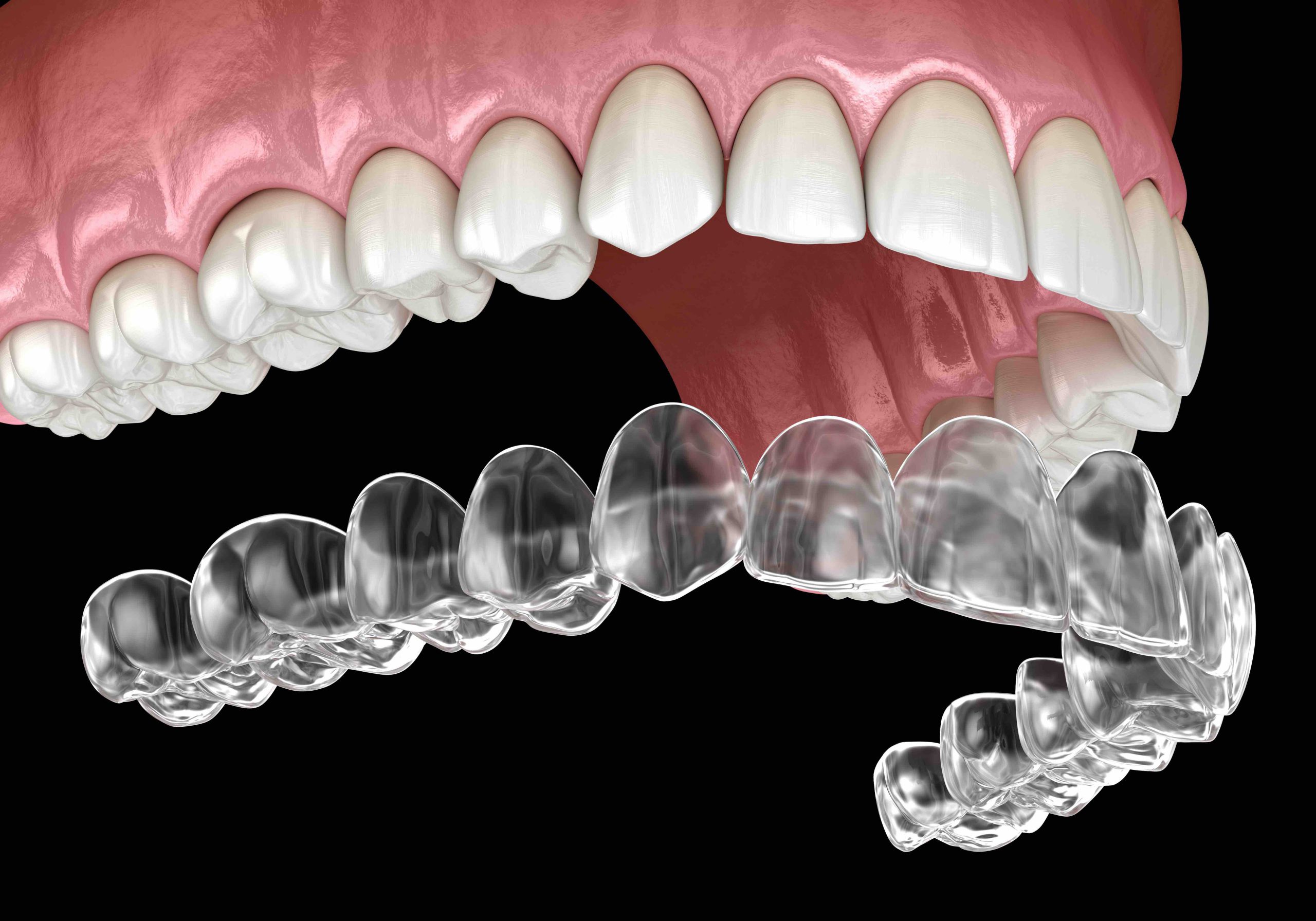 clear braces invisalign graphic clear braces invisalign graphic