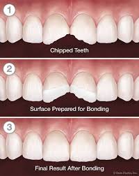 dental bonding chipped teeth dental bonding chipped teeth