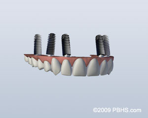 implant retained upper denture implant retained upper denture