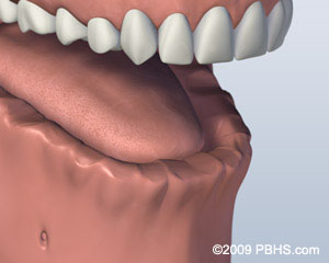 before bar attachment denture before bar attachment denture