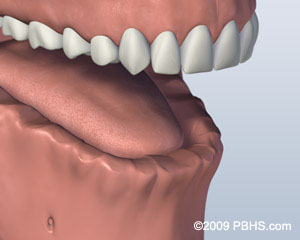 before screw attachment denture before screw attachment denture