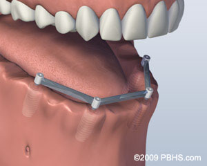 lower jaw bar attachment bar procedure lower jaw bar attachment bar procedure