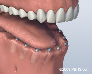 screw attachment denture thousand oaks screw attachment denture thousand oaks