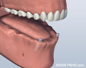 ball attachment denture procedure graphic of ball attachment denture procedure thousand oaks dentist