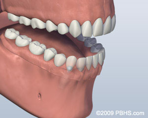graphic of ball attachment denture installed graphic of ball attachment denture installed