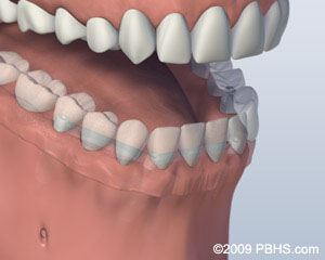 bar attachment denture post procedure bar attachment denture post procedure