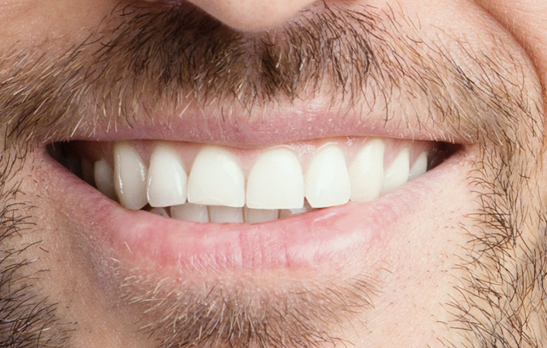 opalescence teeth whitening smile opalescence teeth whitening smile