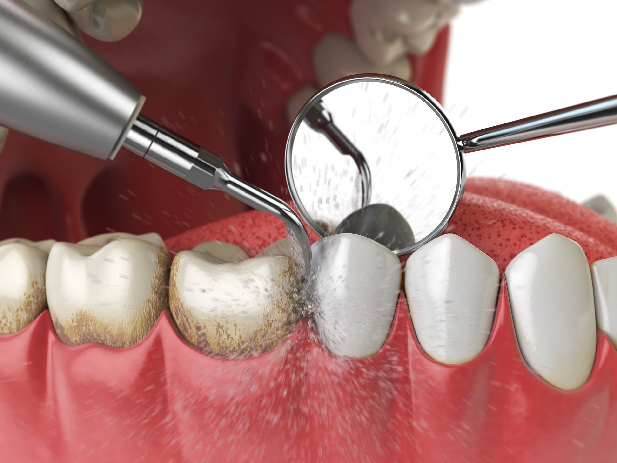 Professional teeth cleaning. Ultrasonic teeth cleaning machine delete dental calculus from human teeth. 3d illustration Professional teeth cleaning. Ultrasonic teeth cleaning machine delete dental calculus from human teeth. 3d illustration