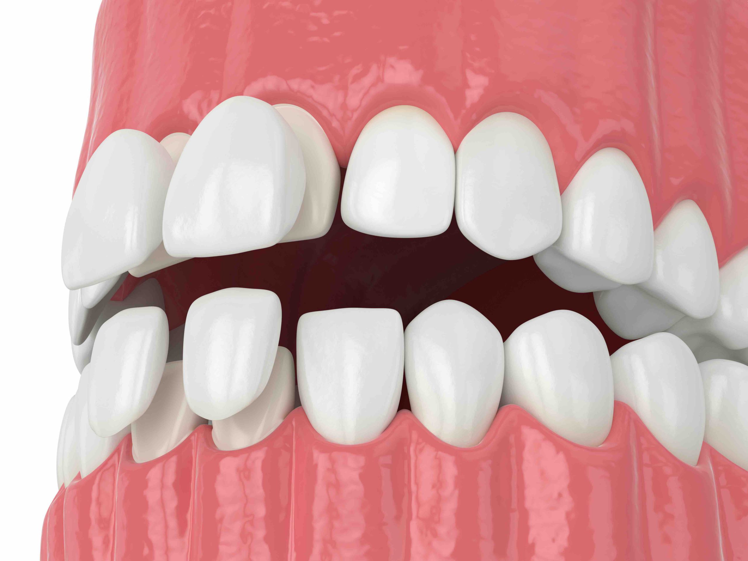 3d render of jaw with upper and lower veneers 3d render of jaw with upper and lower veneers